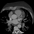 Anomalous origin of left circumflex artery from right coronary sinus (Radiopaedia 72563-83117 A 44).jpg