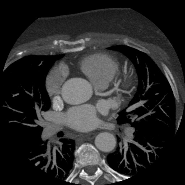 File:Anomalous origin of left circumflex artery from right coronary sinus (Radiopaedia 72563-83117 A 44).jpg
