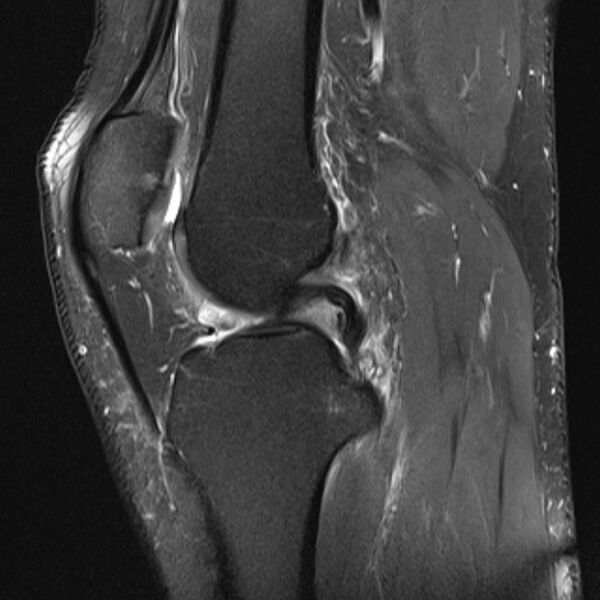 File:Anterior cruciate ligament tear - ramp lesion (Radiopaedia 71883-82322 Sagittal PD fat sat 14).jpg