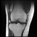 Anterior cruciate ligament tear with posteromedial corner injury, bucket-handle meniscal tear and chondral delamination (Radiopaedia 75501-86744 Coronal T1 12).jpg