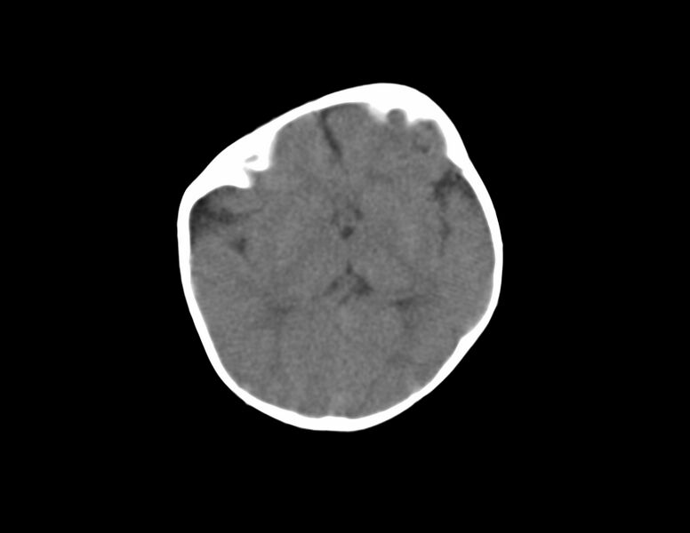 File:Anterior plagiocephaly (Radiopaedia 71836-82273 Axial non-contrast 10).jpg