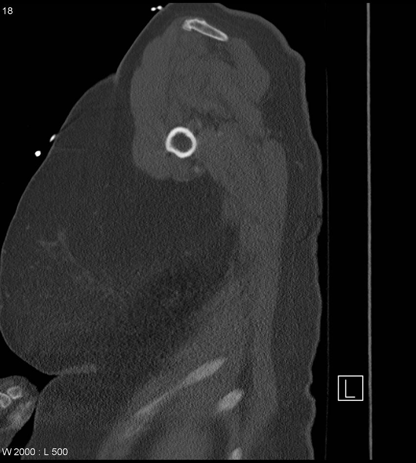 Anterior shoulder dislocation (CT) (Radiopaedia 59032-66309 Sagittal bone window 9).jpg