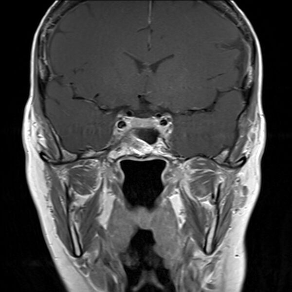 File:Anterior temporal encephalocele (Radiopaedia 82624-96808 Coronal T1 5).jpg