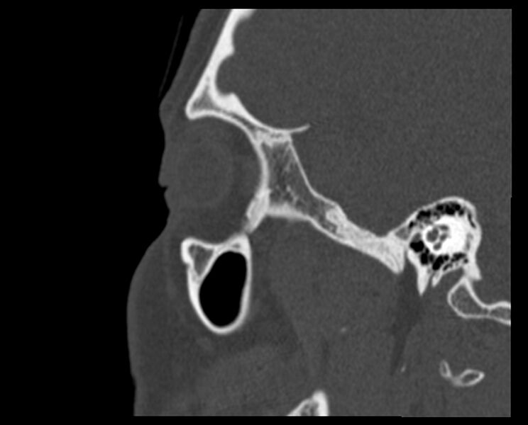 File:Antrochoanal polyp (Radiopaedia 21894-21868 Sagittal bone window 37).jpg