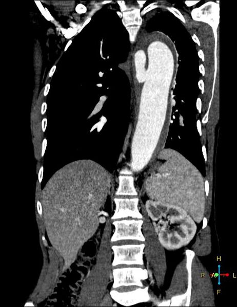 File:Aortic aneurysm and penetrating ulcer (Radiopaedia 23590-23704 B 15).jpg
