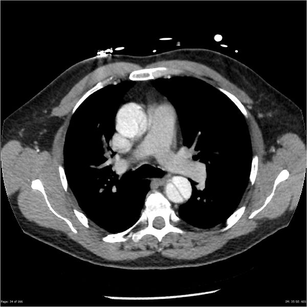 File:Aortic dissection- Stanford A (Radiopaedia 37759-39664 A 25).jpg