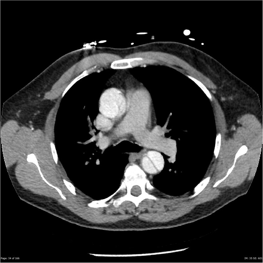 Aortic dissection- Stanford A (Radiopaedia 37759-39664 A 25).jpg