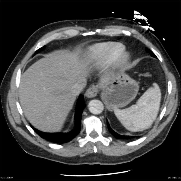 File:Aortic dissection- Stanford A (Radiopaedia 37759-39664 A 59).jpg
