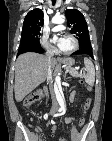 File:Aortic dissection (Radiopaedia 44411-48061 A 21).jpg