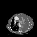 Aortic dissection (Radiopaedia 68763-78691 A 18).jpeg