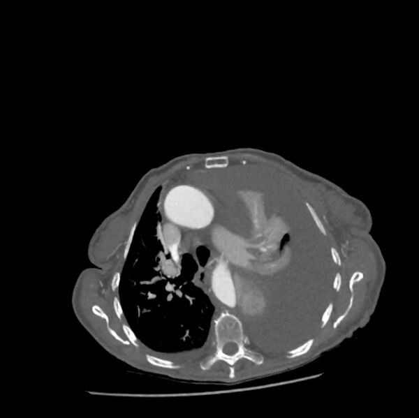File:Aortic dissection (Radiopaedia 68763-78691 A 18).jpeg