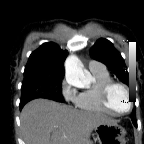 File:Aortic dissection - Stanford type A (Radiopaedia 29247-29659 B 17).jpg