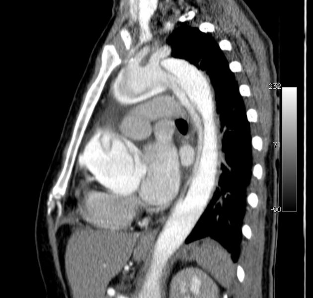 File:Aortic dissection - Stanford type A (Radiopaedia 29247-29659 C 22).jpg