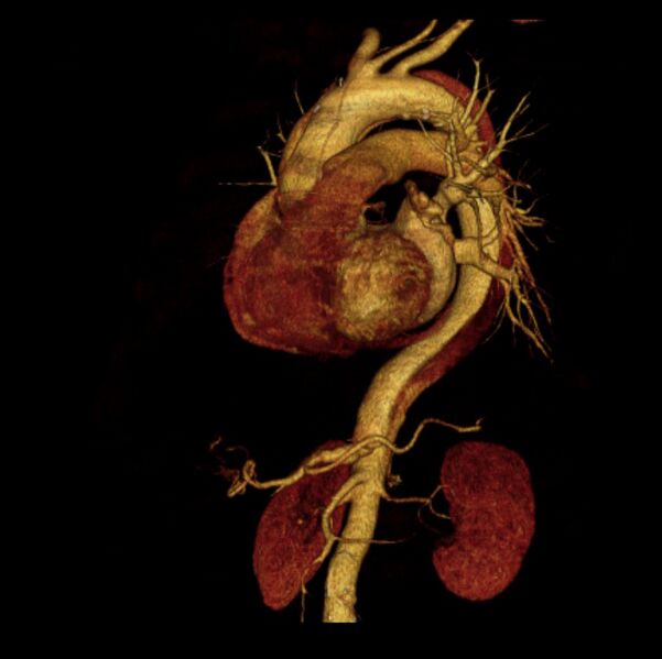 File:Aortic dissection with rupture into pericardium (Radiopaedia 12384-12647 D 33).jpg