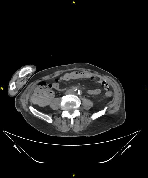File:Aortoenteric fistula (Radiopaedia 84308-99603 Axial non-contrast 231).jpg