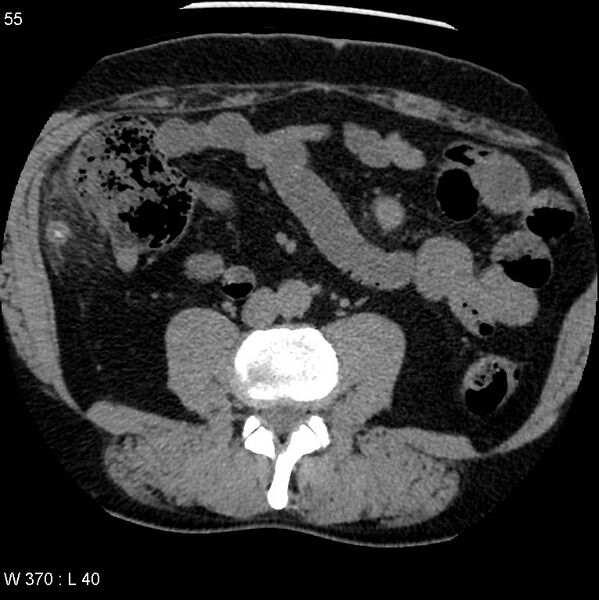 File:Appendicitis (Radiopaedia 12510-12733 Axial non-contrast 22).jpg