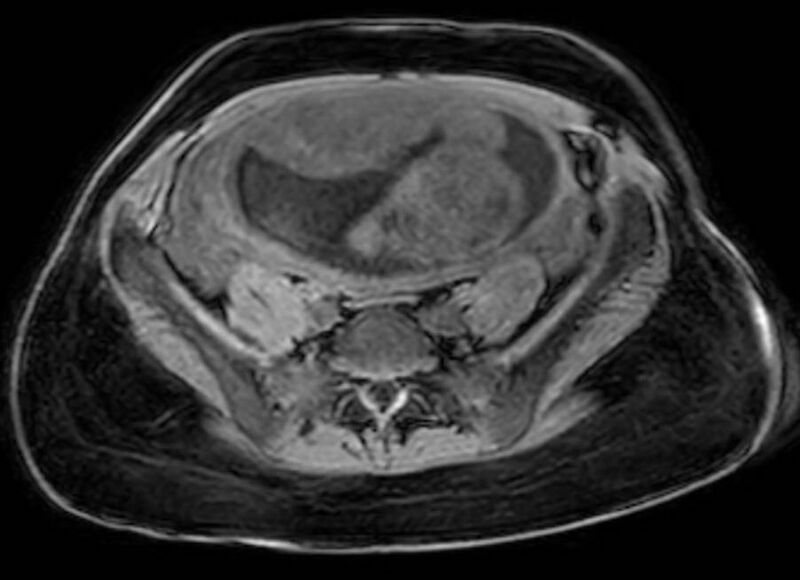 File:Appendicitis in gravida (MRI) (Radiopaedia 89433-106395 Axial DIXON 102).jpg