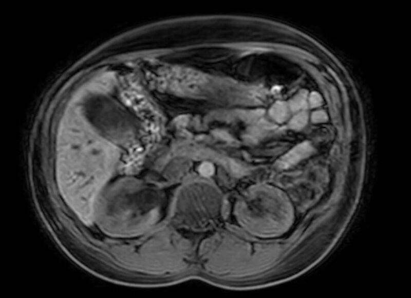 File:Appendicitis in gravida (MRI) (Radiopaedia 89433-106395 Axial DIXON 49).jpg