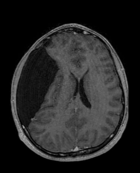 File:Arachnoid cyst- extremely large (Radiopaedia 68741-78451 Axial T1 C+ 50).jpg