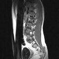 Arachnoid cyst - spinal (Radiopaedia 66835-76157 Sagittal T1 2).jpg