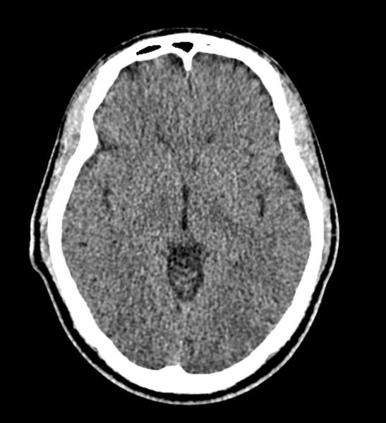 File:Arachnoid cyst of the ambient cistern (Radiopaedia 81301-94986 Axial non-contrast 34).jpg