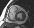 Arrhythmogenic right ventricular cardiomyopathy (Radiopaedia 69431-79307 Short axis cine 127).jpg