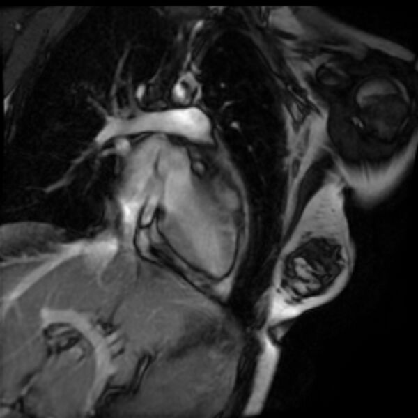 File:Arrhythmogenic right ventricular cardiomyopathy (Radiopaedia 87505-103850 2ch (LV) Cine SSFP 9).jpg