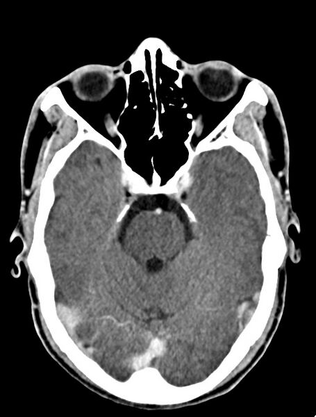 File:Arrow injury to the face (Radiopaedia 73267-84011 Axial C+ delayed 44).jpg