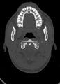 Arrow injury to the head (Radiopaedia 75266-86388 Axial bone window 37).jpg