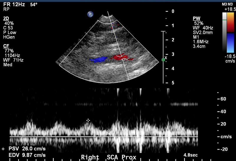 File:Arterial Doppler in left ventricular assist device patients (Radiopaedia 18113-17895 A 1).png