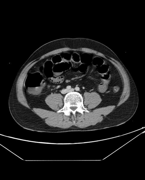 File:Arterial occlusive mesenteric ischemia (Radiopaedia 84641-100054 A 73).jpg