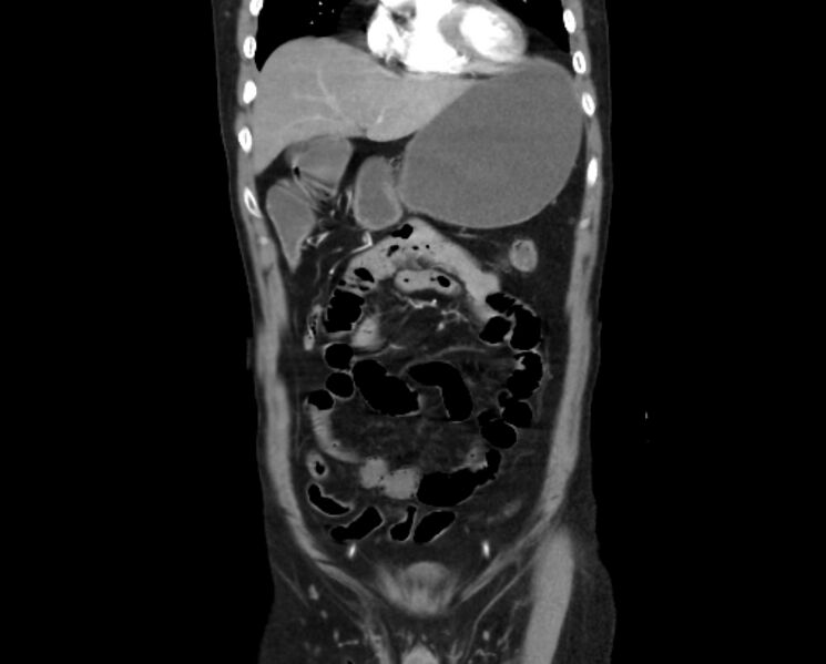 File:Arterial occlusive mesenteric ischemia (Radiopaedia 84641-100060 B 15).jpg