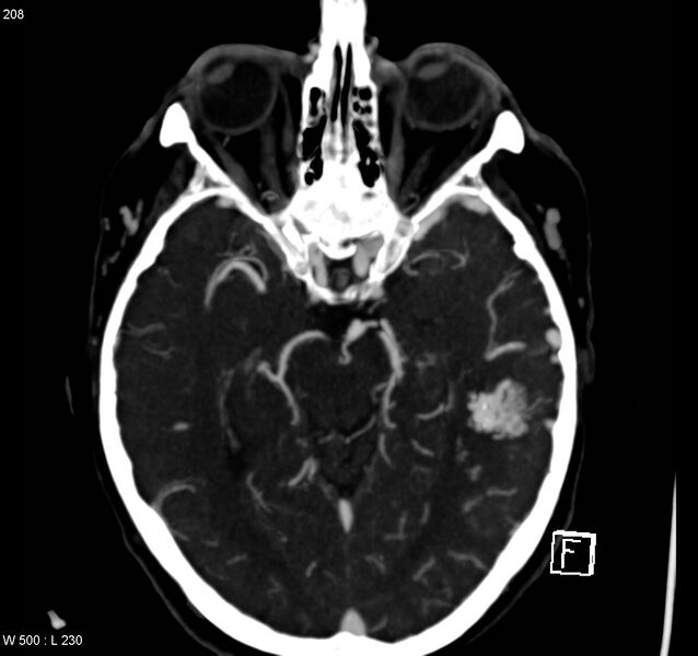 File:Arteriovenous malformation - cerebral (Radiopaedia 8172-14682 A 7).jpg