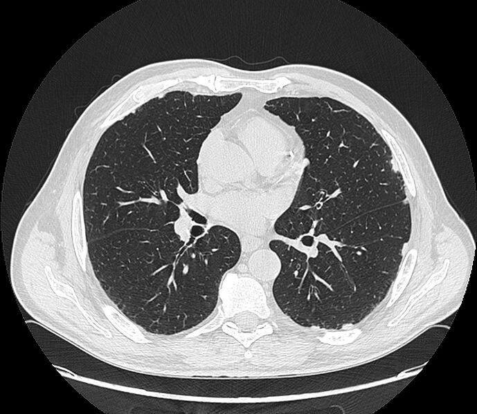 File:Asbestos pleural placques (Radiopaedia 57905-64872 Axial lung window 130).jpg
