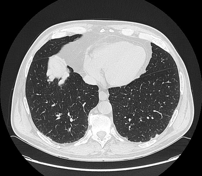 File:Asbestos pleural placques (Radiopaedia 57905-64872 Axial lung window 179).jpg