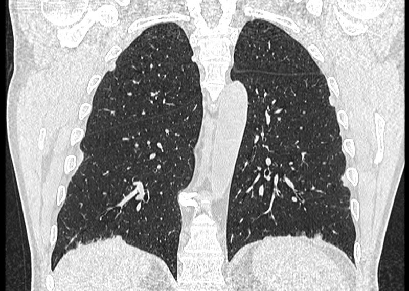 File:Asbestos pleural placques (Radiopaedia 57905-64872 Coronal lung window 205).jpg