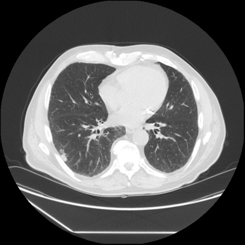 Asbestosis complicated by lung cancer (Radiopaedia 45834-50116 Axial lung window 42).jpg