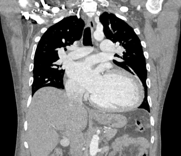 File:Ascending aortic aneurysm (Radiopaedia 86279-102297 B 33).jpg