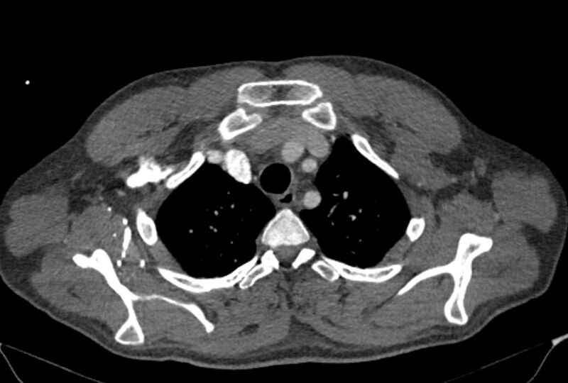 File:Ascending aortic aneurysm (Radiopaedia 86279-102297 C 8).jpg