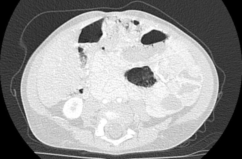 File:Asplenia syndrome (Radiopaedia 73083-83792 Axial lung window 109).jpg