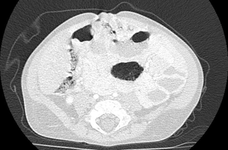 File:Asplenia syndrome (Radiopaedia 73083-83792 Axial lung window 112).jpg