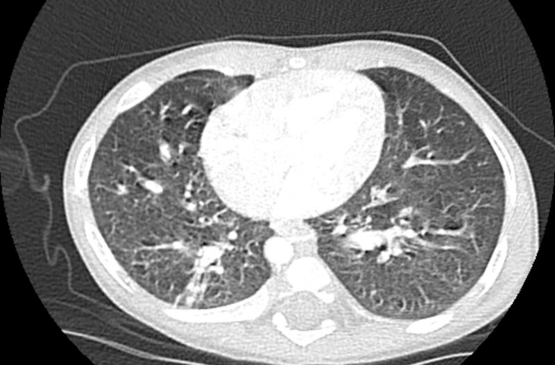 File:Asplenia syndrome (Radiopaedia 73083-83792 Axial lung window 47).jpg