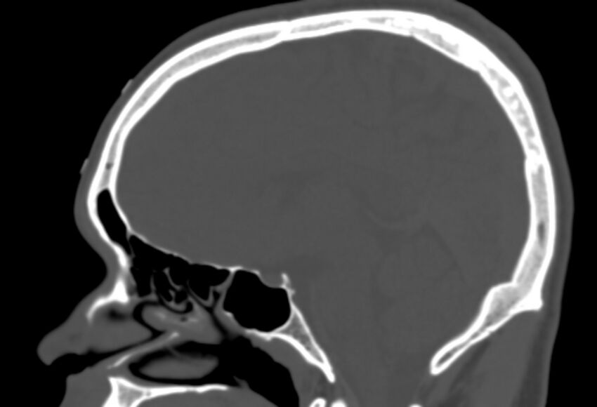 Asymptomatic occipital spur (Radiopaedia 87753-104201 Sagittal bone window 161).jpg