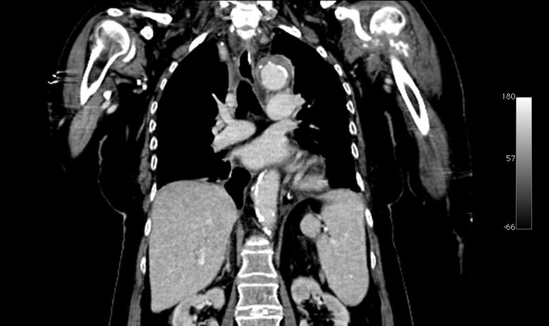 File:Atypical dissection of the thoracic aorta (Radiopaedia 10975-78320 B 23).jpg