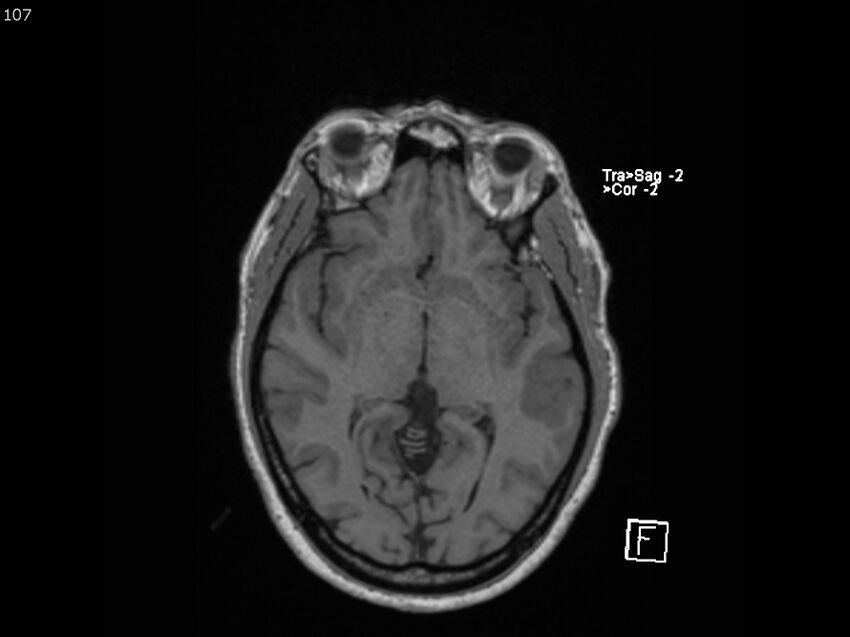 Atypical meningioma - intraosseous (Radiopaedia 64915-74572 Axial T1 107).jpg