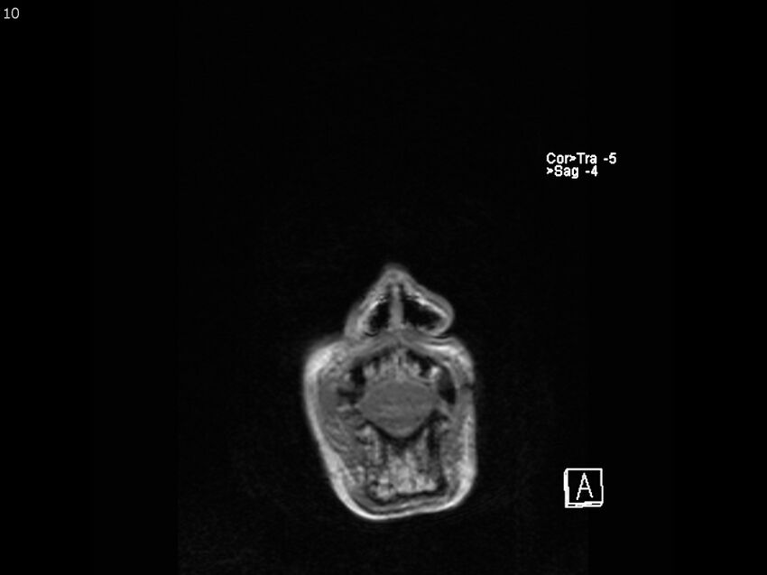 Atypical meningioma - intraosseous (Radiopaedia 64915-74572 Coronal T1 10).jpg