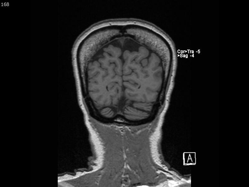 File:Atypical meningioma - intraosseous (Radiopaedia 64915-74572 Coronal T1 168).jpg