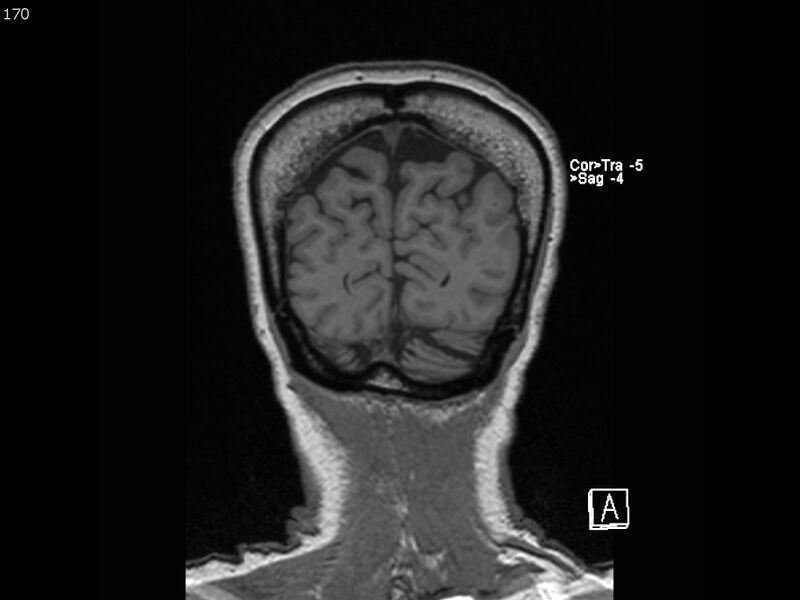 File:Atypical meningioma - intraosseous (Radiopaedia 64915-74572 Coronal T1 170).jpg