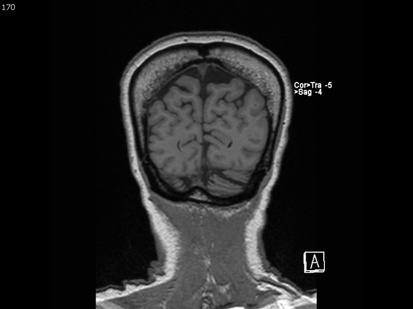 Atypical meningioma - intraosseous (Radiopaedia 64915-74572 Coronal T1 170).jpg
