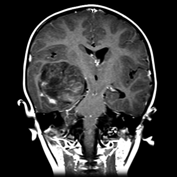 File:Atypical teratoid rhabdoid tumor (AT-RT) (Radiopaedia 6073-7553 Coronal T1 C+ 1).jpg